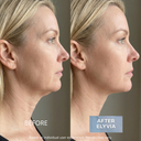 ELYVIA Complete Skin System™